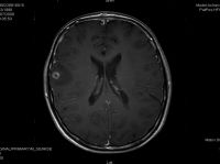 Figuras 1 y 2. Imágenes de RM cerebral antes del inicio del tratamiento. Se observan dos lesiones focales hipointensas en la unión corticosubcortical de los lóbulos frontal y occipital derechos. La primera de las lesiones muestra un realce anular en las secuencias posgadolinio y cursa con un edema asogénico perilesional. Lesiones sugestivas de granulomas calcificados inespecíficos en las localizaciones