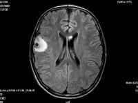 Figuras 1 y 2. Imágenes de RM cerebral antes del inicio del tratamiento. Se observan dos lesiones focales hipointensas en la unión corticosubcortical de los lóbulos frontal y occipital derechos. La primera de las lesiones muestra un realce anular en las secuencias posgadolinio y cursa con un edema asogénico perilesional. Lesiones sugestivas de granulomas calcificados inespecíficos en las localizaciones