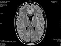 Figura 3. Estabilidad de las lesiones intraparenquimatosas calcificadas en un paciente con antecedente de neurocisticercosis, sin signos que sugieran actividad